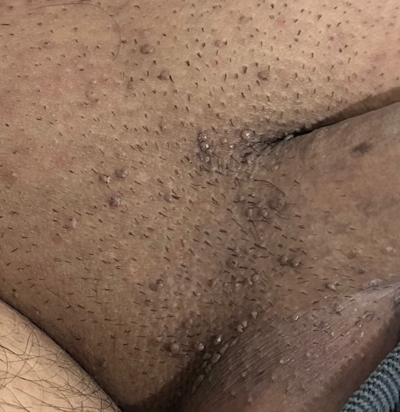 Genital siğil (kondilom) klinik görüntü 1 &mdash; Görüldüğü gibi siğiller genital bölgenin tamamına yayılabilir.