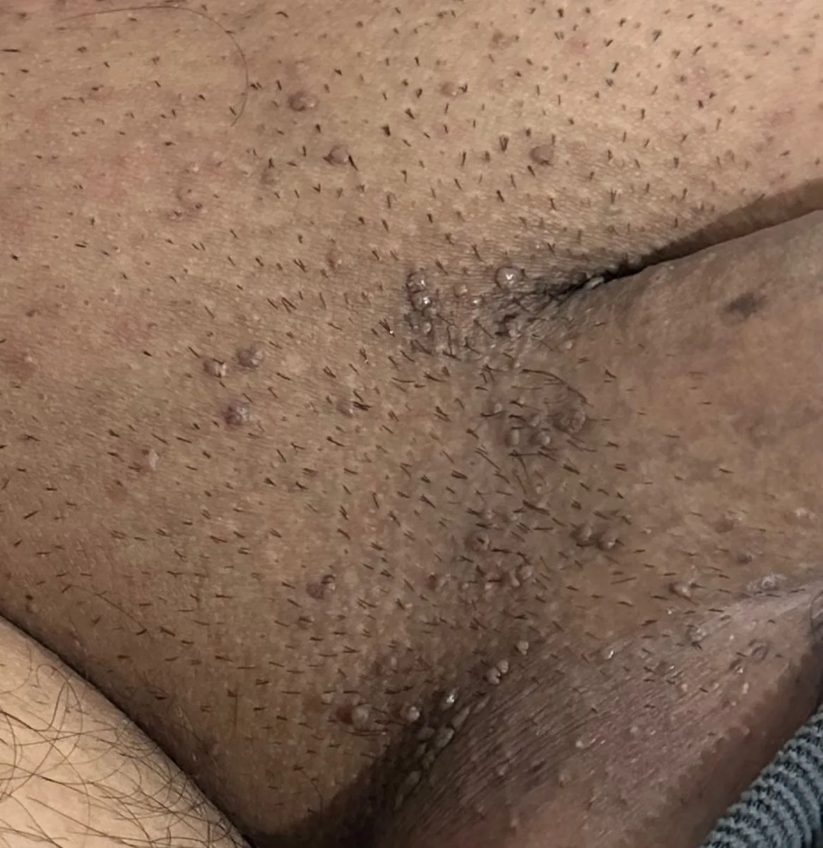 Genital siğil (kondilom) klinik görüntü 1 &mdash; Görüldüğü gibi siğiller genital bölgenin tamamına yayılabilir.