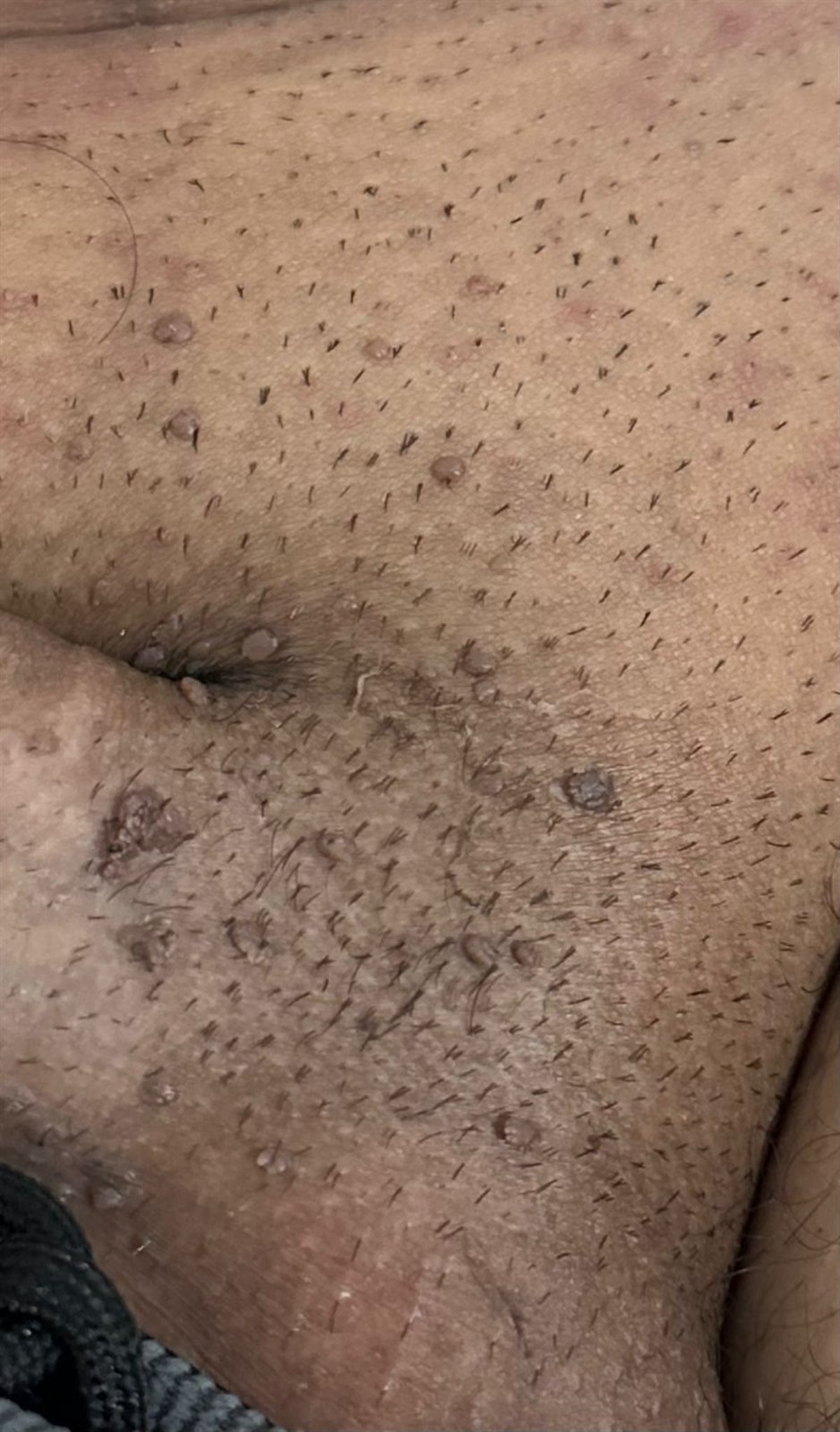 Genital siğil (kondilom) klinik görüntü 3 &mdash; Lezyonların, prezervatifin örtmediği alanlarda geliştiği dikkati çekiyor.