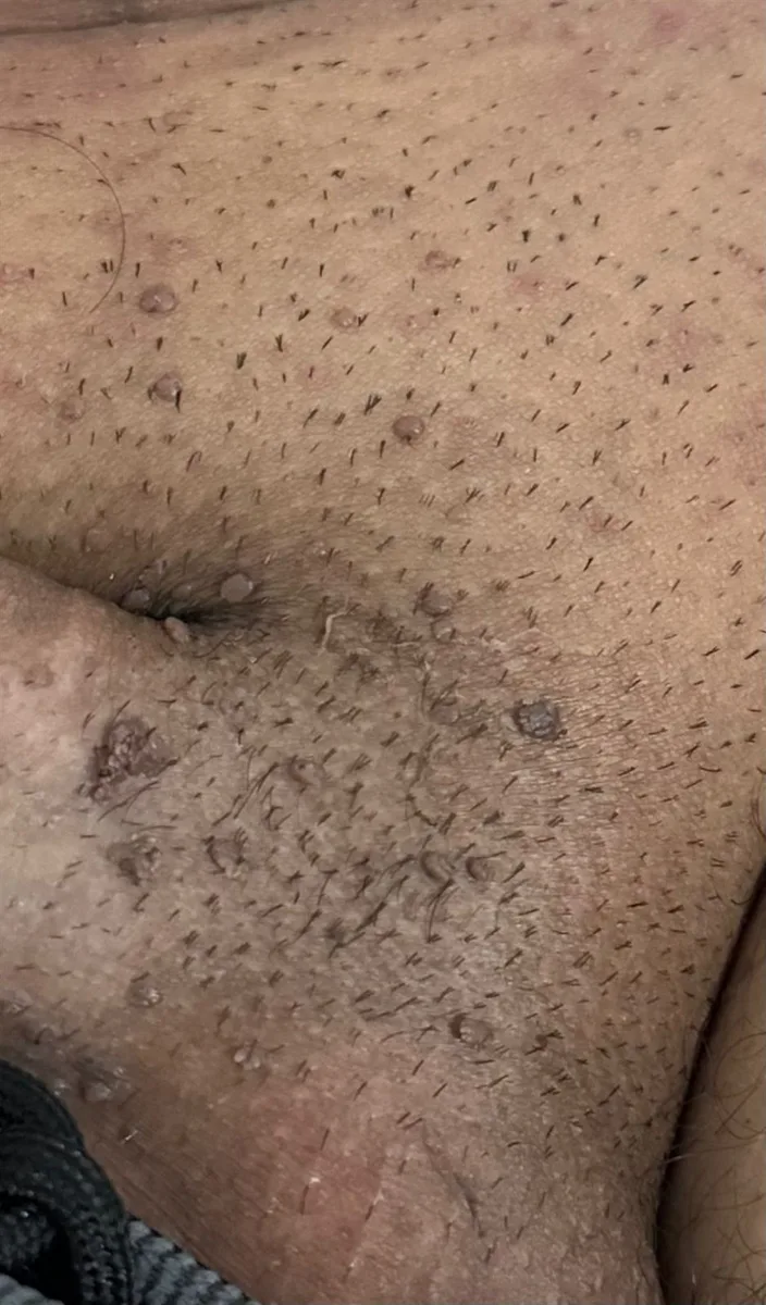 Genital siğil (kondilom) klinik görüntü 3 &mdash; Lezyonların, prezervatifin örtmediği alanlarda geliştiği dikkati çekiyor.