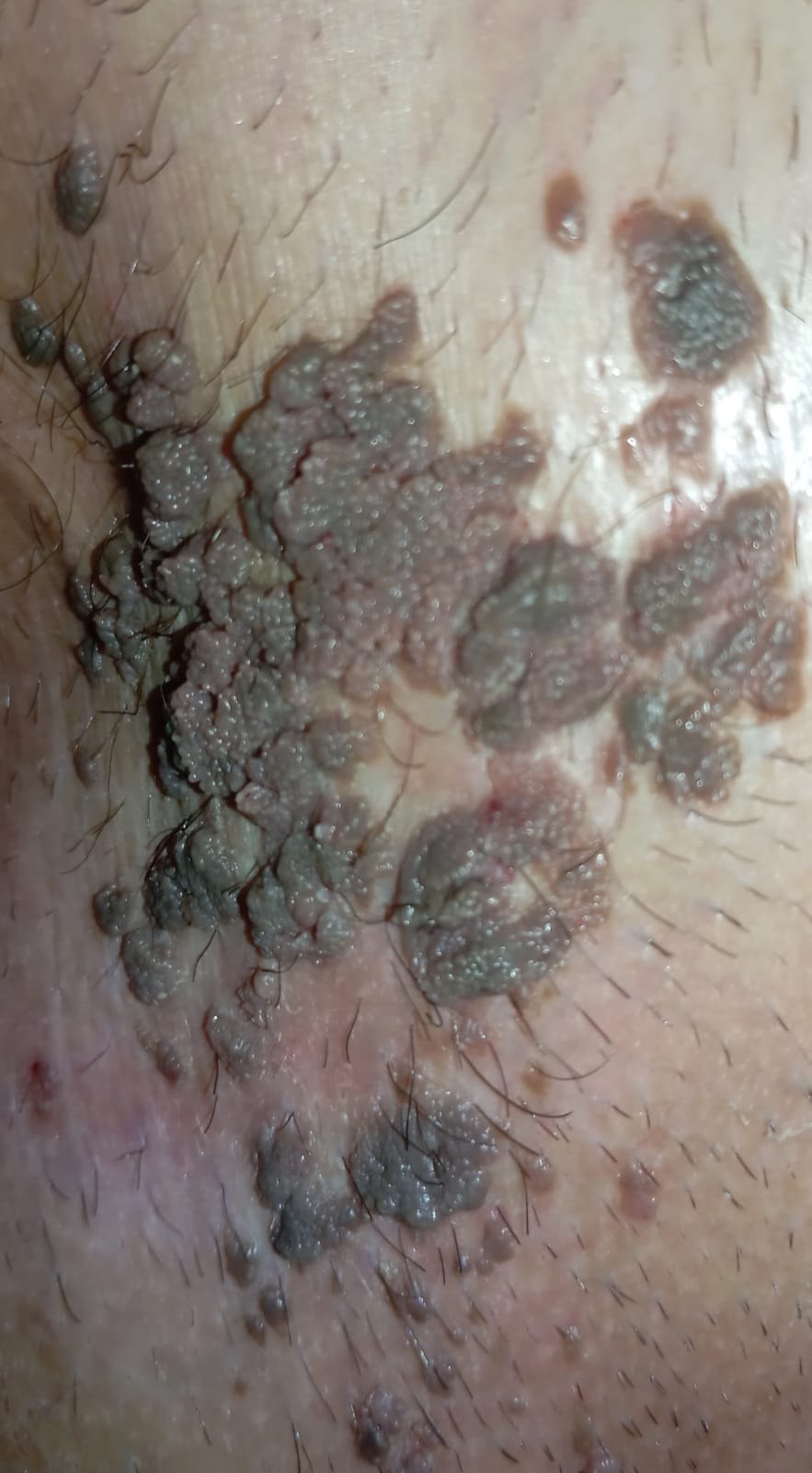 Genital siğil (kondilom) klinik görüntü 4 &mdash; Yakıcı krem ya da ilaçlarla tedavi edilmeye çalışılan genital siğiller bu şekilde hızla çoğalabilir.