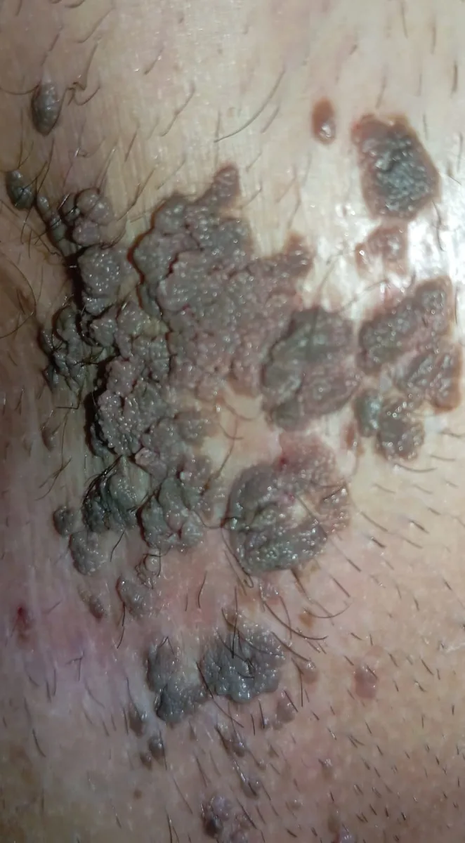 Genital siğil (kondilom) klinik görüntü 4 &mdash; Yakıcı krem ya da ilaçlarla tedavi edilmeye çalışılan genital siğiller bu şekilde hızla çoğalabilir.