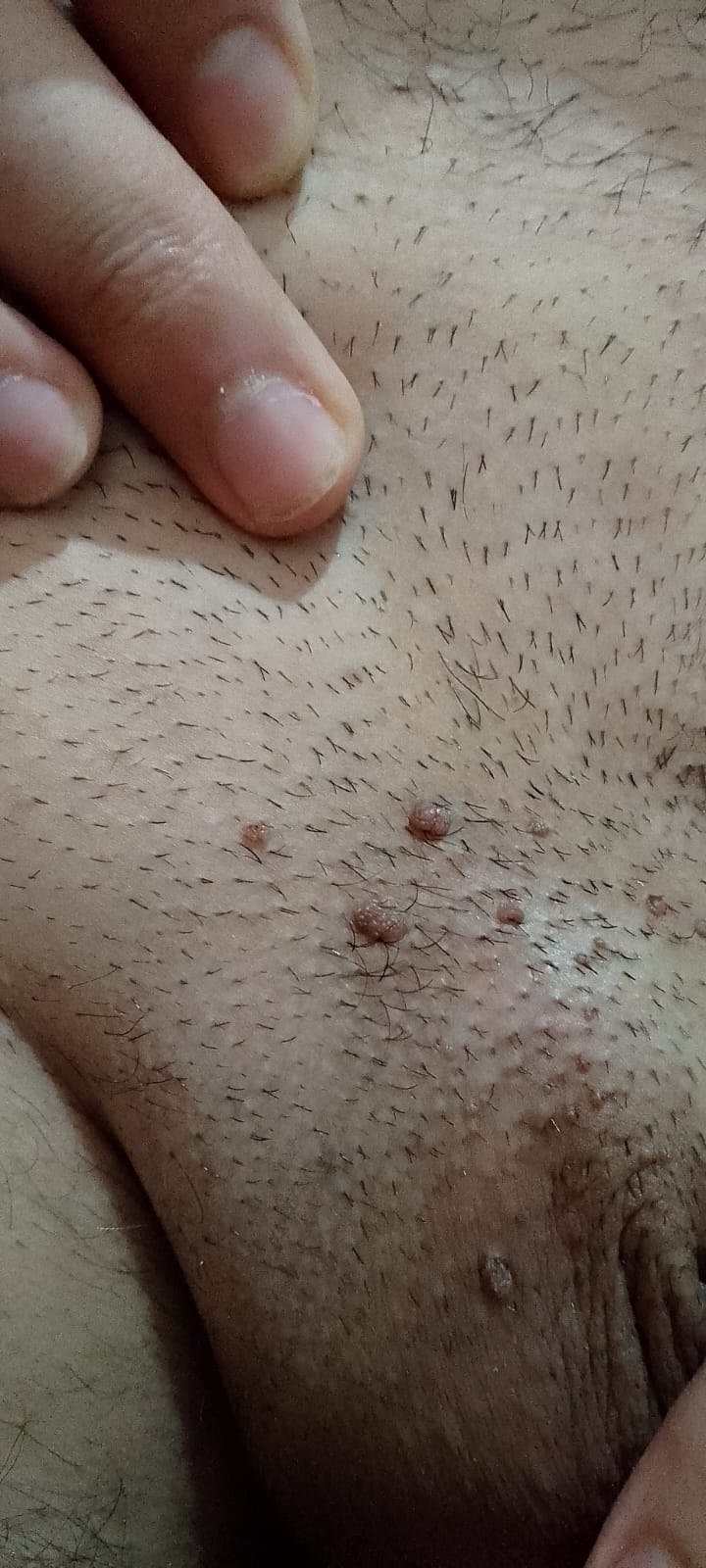 Genital siğil (kondilom) klinik görüntü 5 &mdash; Mons pubis (kıllı genital bölge) yerleşimli HPV siğilleri. Burası da prezervatifin örtmediği alanlardandır.