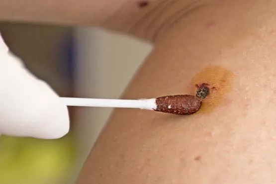 İlaçla HPV tedavisi