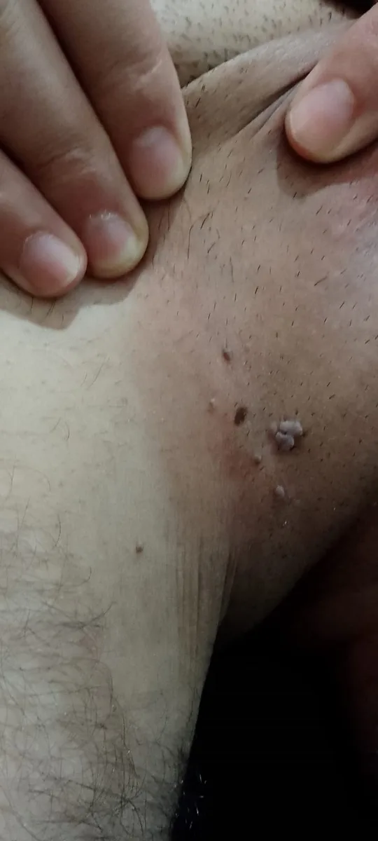 Kasık siğili klinik görüntü 1 &mdash; Kasık bölgesinde siğil. Özellikle tahrişe uğrayan alanlarda görülür; kaşınıp kanatılması çoğalmasına yol açabilir.