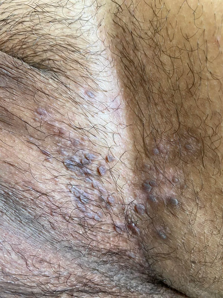 Kasık siğili klinik görüntü 2 &mdash; Kasık bölgesinde siğil. Nemli ve tahrişli alanlarda sık izlenir. Cilt katlantısı (skin tag) ve molluscum ile karışabilir.