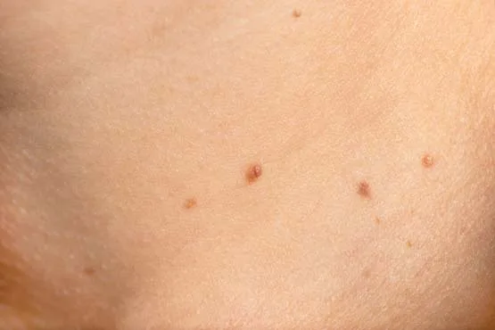 Kasık siğili: kasık kıvrımında ten renginde, kabarık HPV siğili