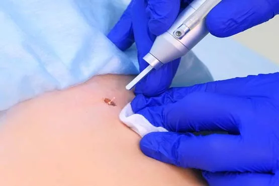 Lazer ile genital siğil tedavisi