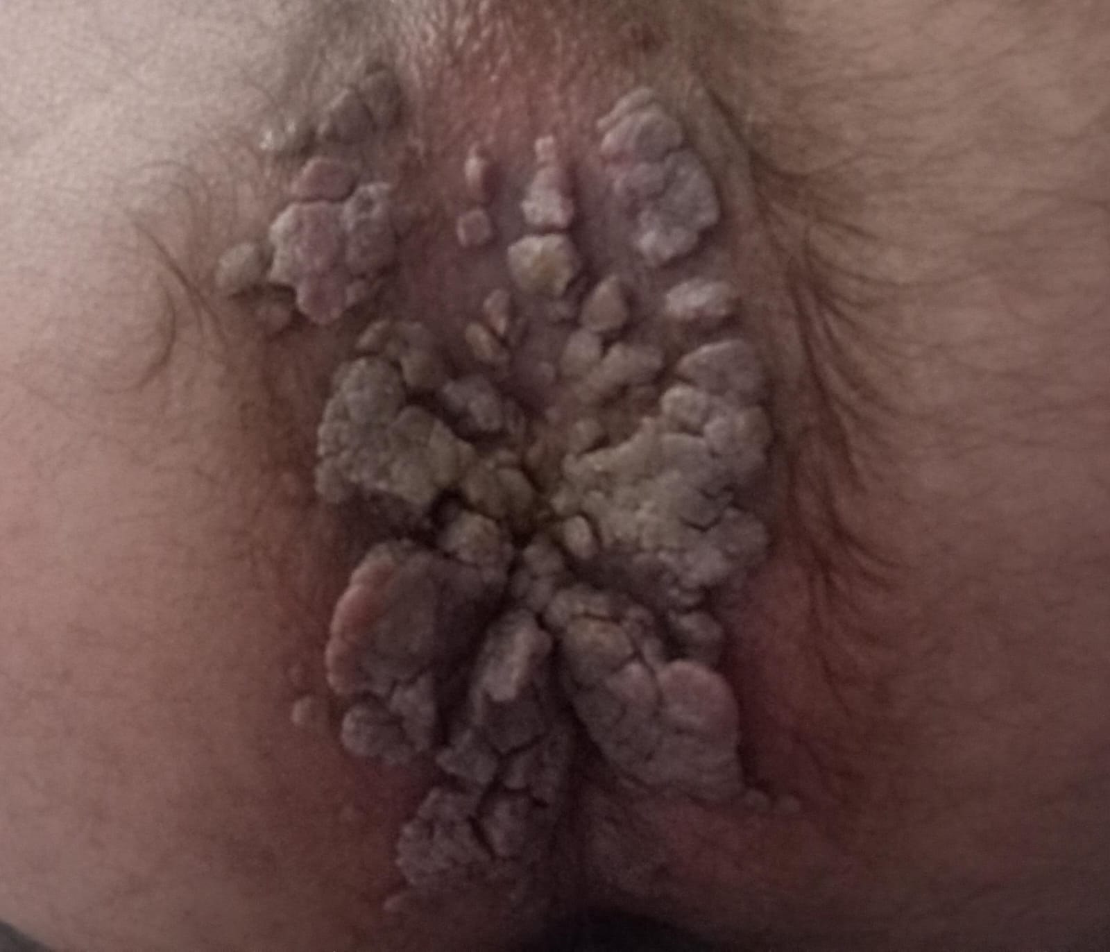 Makatta genital siğil (perianal kondilom) klinik görüntü &mdash; Makat çevresinde perianal kondilom.