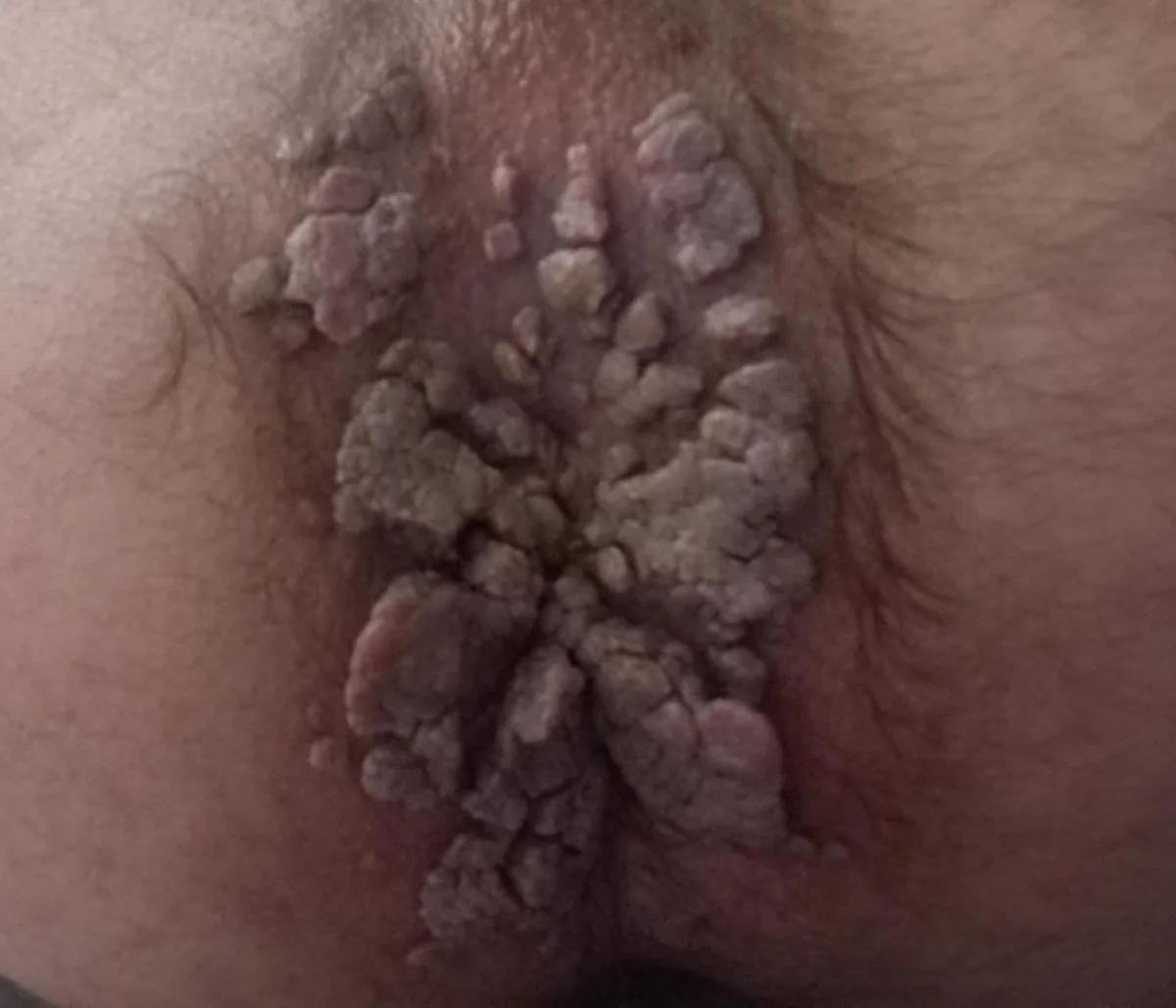 Makatta genital siğil (perianal kondilom) klinik görüntü &mdash; Makat çevresinde perianal kondilom.