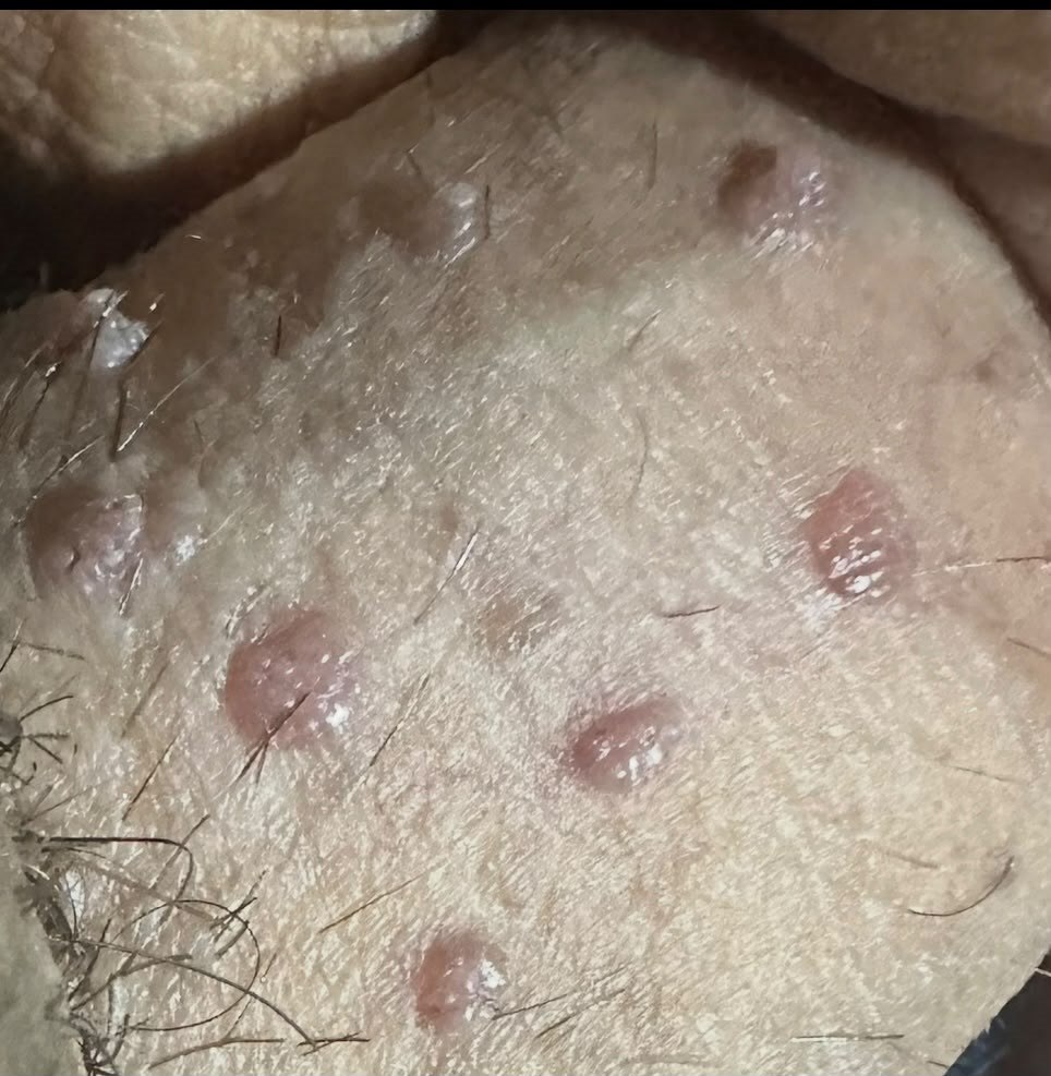 Peniste genital siğil (penil kondilom) klinik görüntü &mdash; Penis üzerinde kondilom. Siğiller her zaman karnabahar şeklinde olmaz; bazen ciltten kabarık, koyu renkli (hiperpigmente) lezyonlar hâlinde görülür.