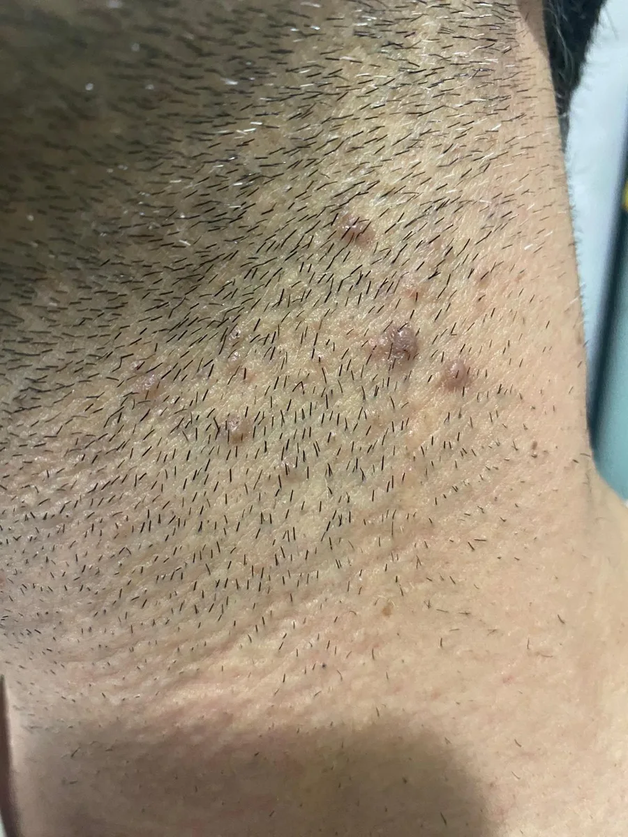 Boyunda ve koltuk altında et beni / siğil klinik görüntü 1 &mdash; Boyunda siğil. Bu görüntüdeki lezyon gerçek siğildir; tıraş olmakla yayılabilir.