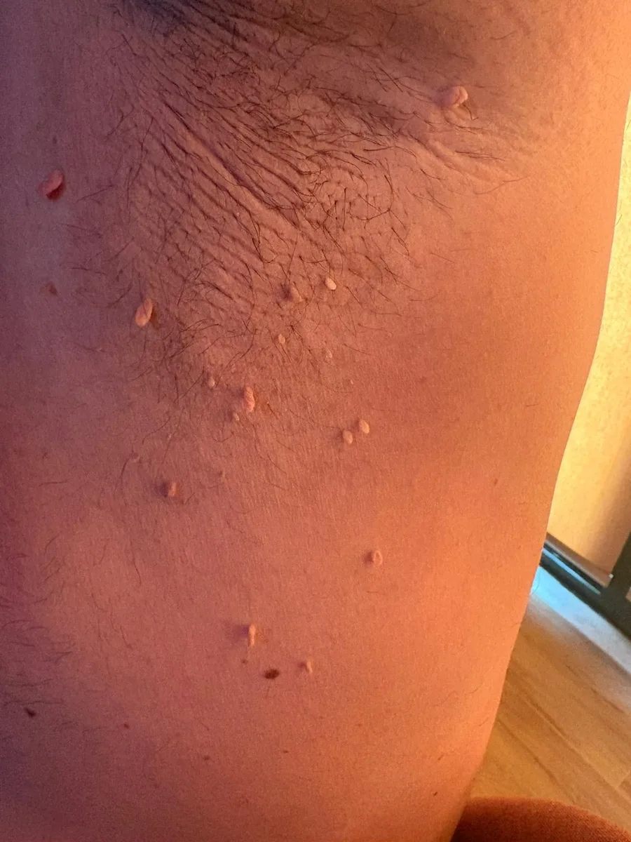 Boyunda ve koltuk altında et beni / siğil klinik görüntü 2 &mdash; Koltuk altında skin tag (et beni). Yumuşak, saplı ve ten renginde; HPV ile ilgisi yoktur, bulaşıcı değildir.