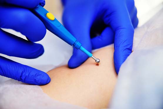 HPV treatment with electrocautery
