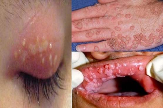 HPV symptoms