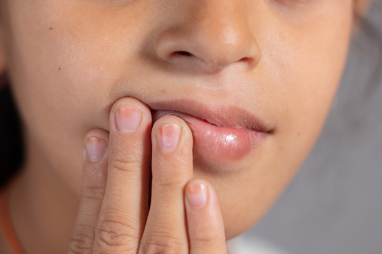 HPV oral transmission