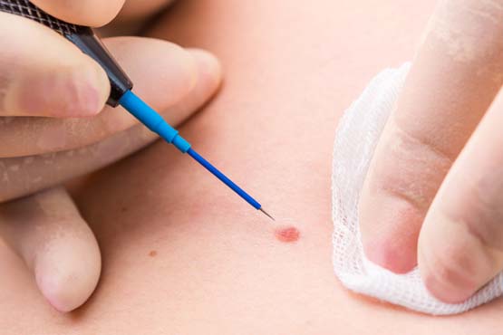 HPV Treatment with Radiofrequency