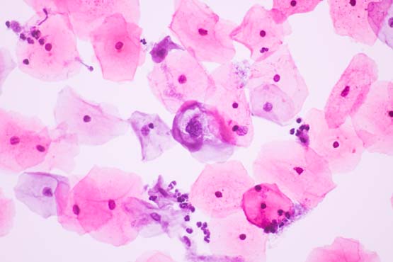 smear test