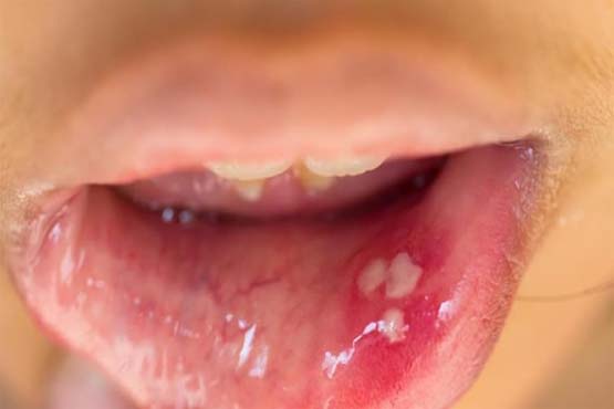 Papilloma virus nedir, Hpv hastaliginin tedavisi