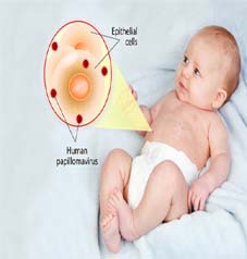 Yenidoğan Bebekte HPV