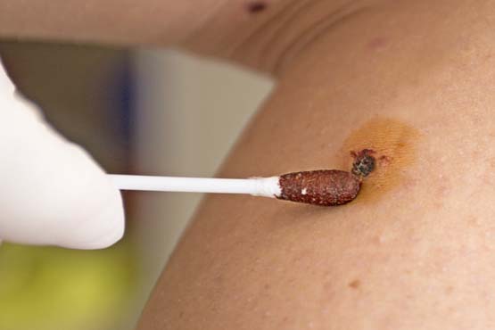 HPV treatment with medication