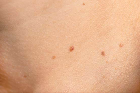 Groin wart