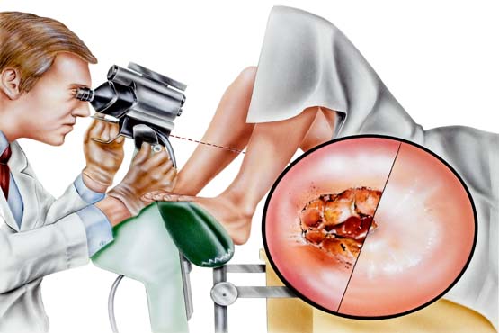 The colposcopy procedure