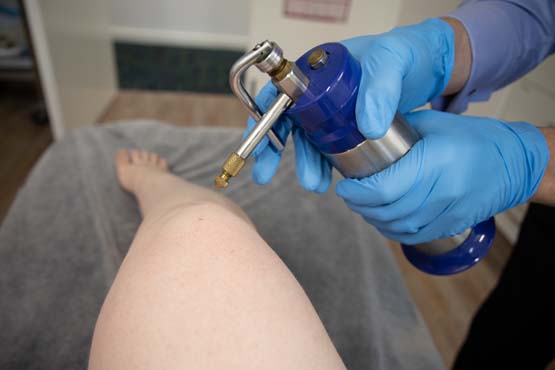 HPV treatment with cryotherapy