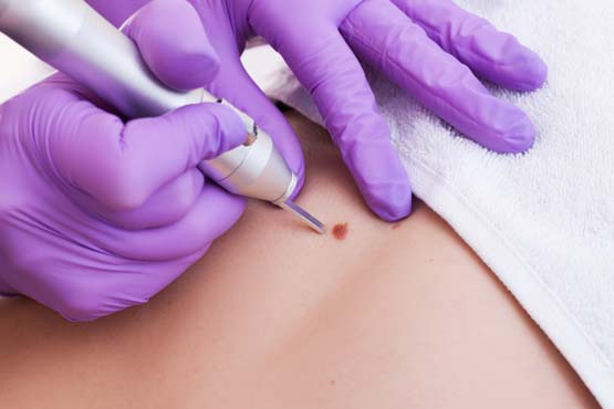 Wart Burning